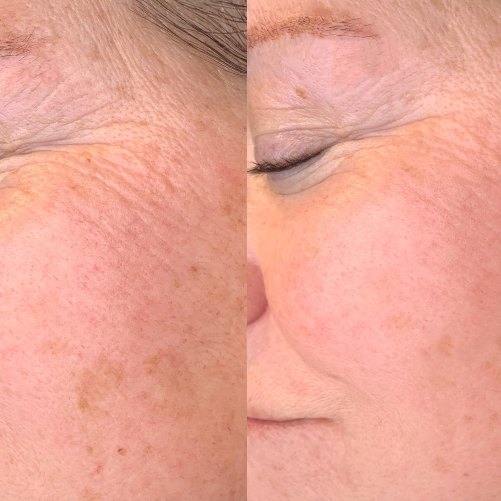 ALL IN ONE INJECTOR SET + DESINFEKTION