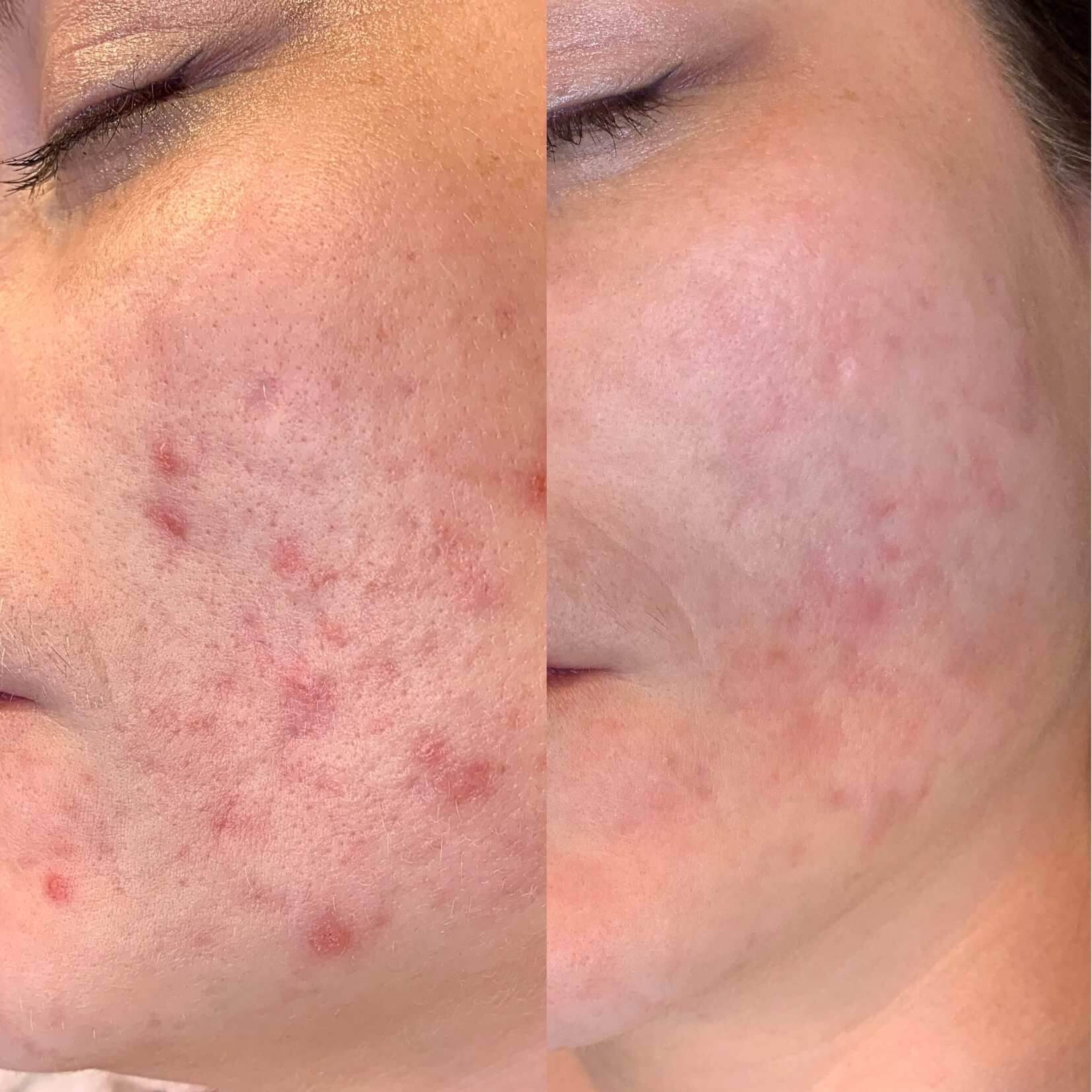 ALL IN ONE INJECTOR SET + DESINFEKTION