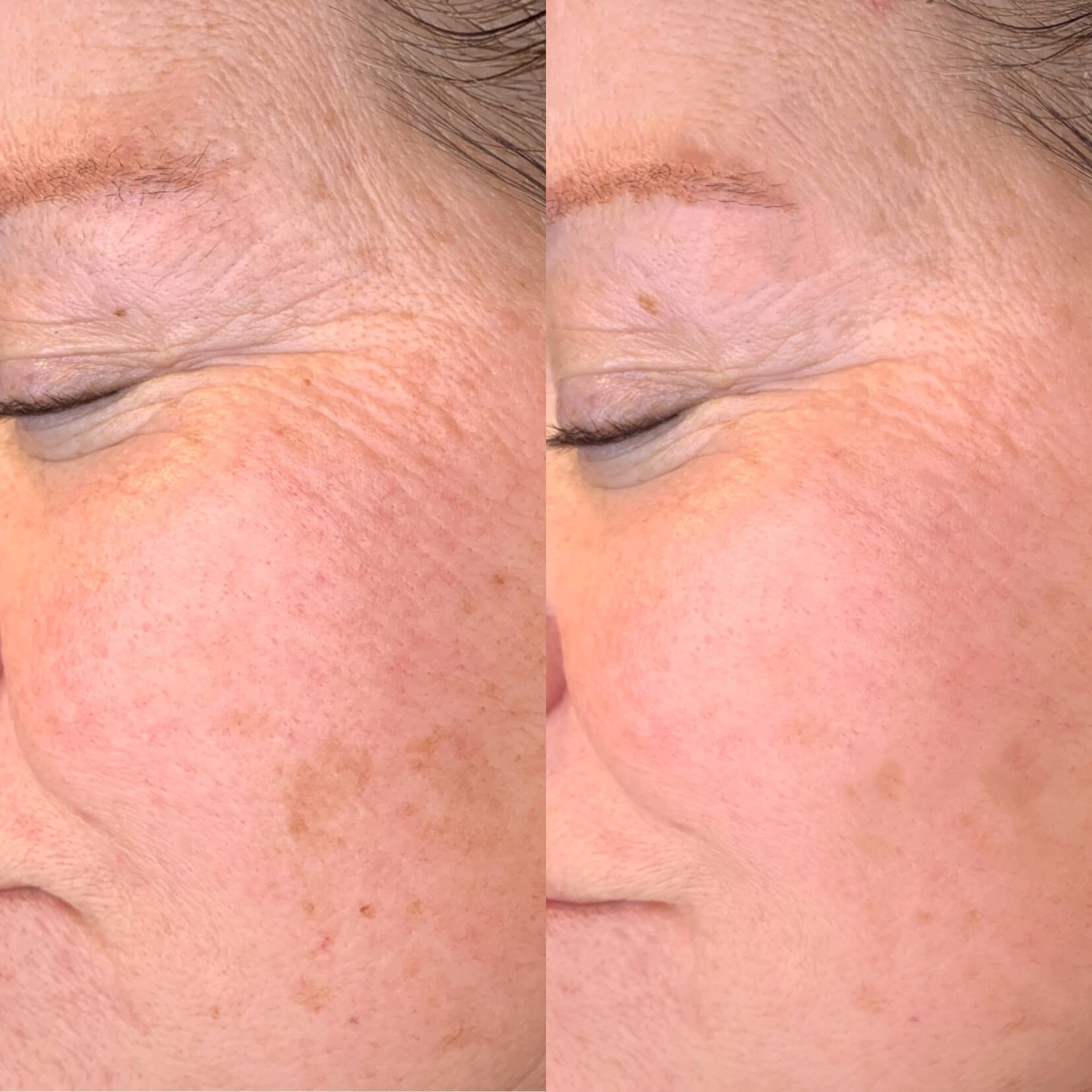 MICROINJECTOR  SOFT