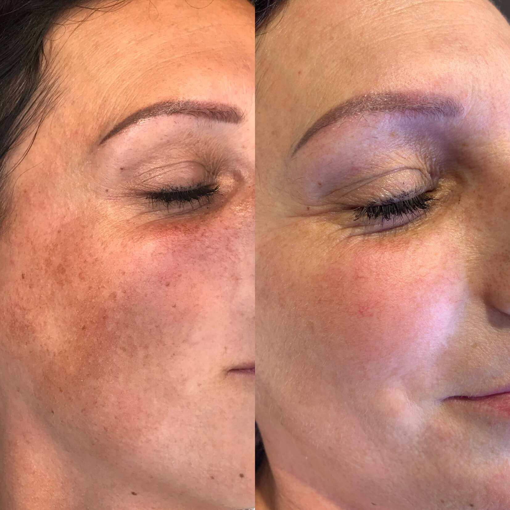 MICROINJECTOR  SOFT