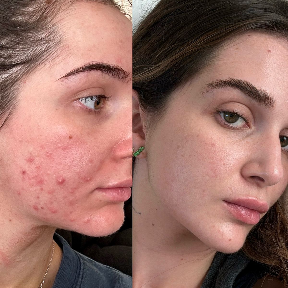 ALL IN ONE INJECTOR SET